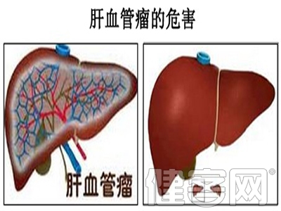 肝血管瘤會對身體產生的6大危害