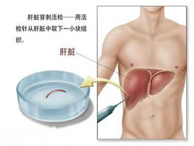 部分肝炎患者為什麼要做肝穿刺？