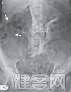 病例:氣腹引起的肝旋轉