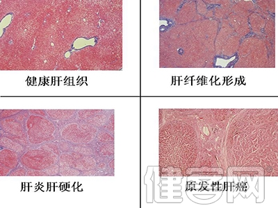 乙肝用藥不可盲目停與換 肝纖維化決定乙肝停藥