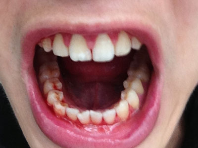 牙龈出血是肝不好的表現 預防肝病遠離8個壞習慣