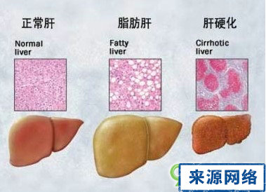 脂肪肝危害 脂肪肝 脂肪肝影響 脂肪肝肝癌 脂肪肝硬化