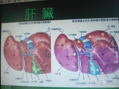 慢性肝炎後肝硬化的治療方法