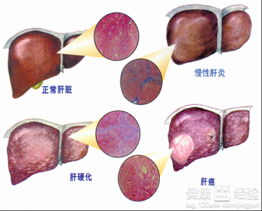 膽汁性肝硬化症狀有哪些？