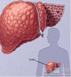 了解一下肝硬化穴位按摩保肝的方法