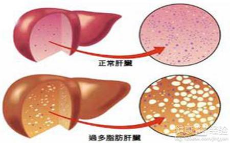 酒精性脂肪肝的病因及發病機制