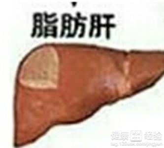 脂肪肝治療3大原則