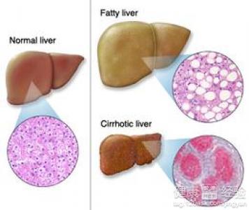 脂肪肝如何治療呢