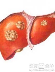 肝囊腫跟惡性腫瘤之間的差別