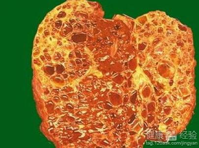 中醫治療肝囊腫方法