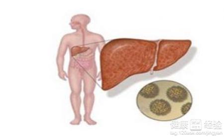 怎麼治多發性肝囊腫