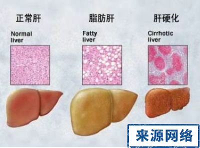 脂肪肝 脂肪肝檢查 脂肪肝怎麼辦