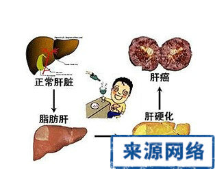 脂肪肝 防治脂肪肝 脂肪肝防治 脂肪肝治療 脂肪肝預防