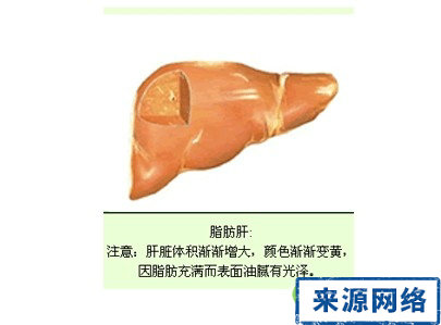 脂肪肝危害 脂肪肝症狀 脂肪肝影響 脂肪肝肝癌 脂肪肝硬化